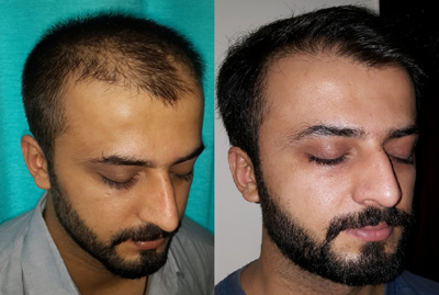 Hair Transplant in Dubai 7900 AED (min 5000 Hairs) Low Cost, Top Clinic,  Best Doctors | Cosmocare Dermatologist Dubai
